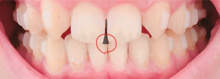 前歯の隙間３