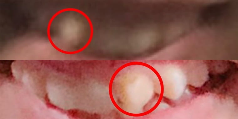 犬歯が目立つ歯の目印