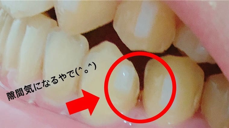 歯の隙間
