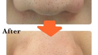 ハイドラフェイシャルの鼻のビフォーアフター
